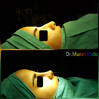 Micromotor Assisted Rhinoplasty, Nose Job Istanbul,Female Nose Aesthetic Turkey,