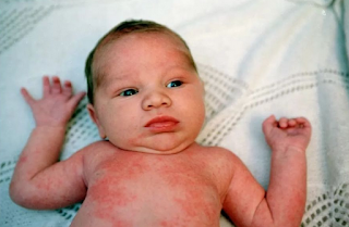 Alergi Pada Bayi | Alergi Susu Pada Bayi