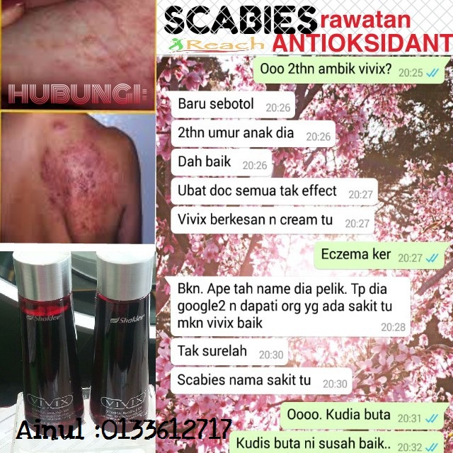 Jangkitan Kudis Buta atau Scabies Pada Bayi dan Orang Dewasa