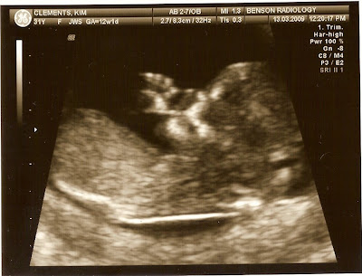 12 5 week ultrasound. Here are our first ultrasound