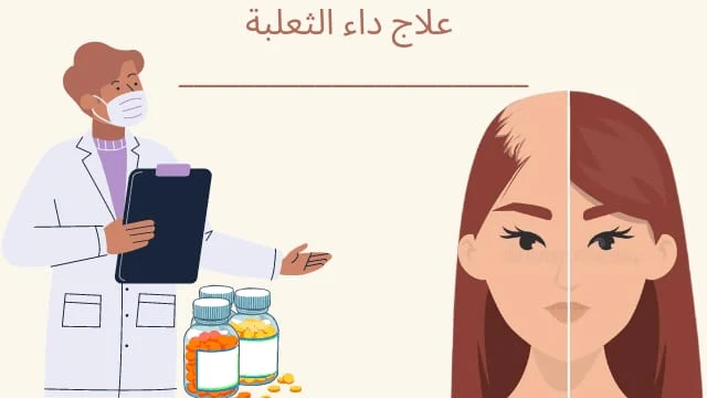 علاج داء الثعلبة