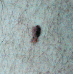 My melanoma