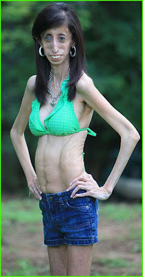 Wanita Terkurus Di Dunia, Di Amerika, Texas, Lizzie Velasquez, Mahasiswa Komunikasi, Neonatal Progeroid Syndrome, sindrom,Wanita Terkurus Sedunia