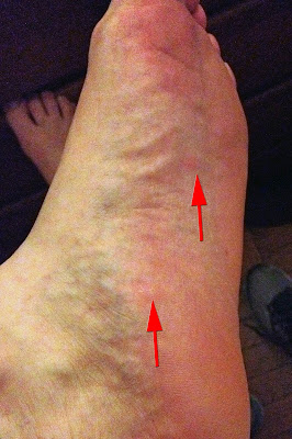 Day 3, two barely-visible spots on my left foot