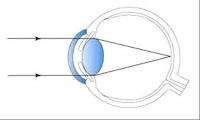 BANDUNG LASIK CENTER Deteksi dan Koreksi Kelainan 