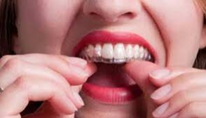 So sánh niềng răng Invisalign với Clear Aligner