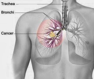 Small Cell Lung Cancer Treatment