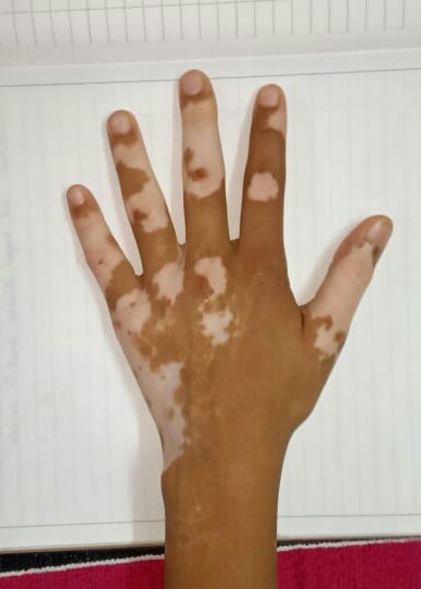 Leukoderma, vitiligo