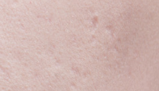  laser treatment for acne scars