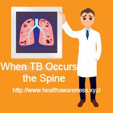 When TB Occurs in the Spine