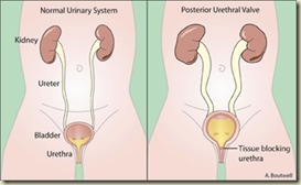 posteriorurethralvalves-full