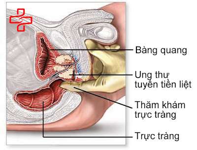 Tổng quan về bệnh viêm tuyến tiền liệt