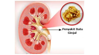 obat batu ginjal