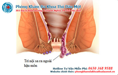 Biểu hiện và cách hỗ trợ chữa trị trĩ nội cấp độ 3