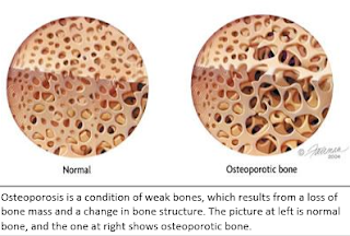 OSTEOPOROSIS