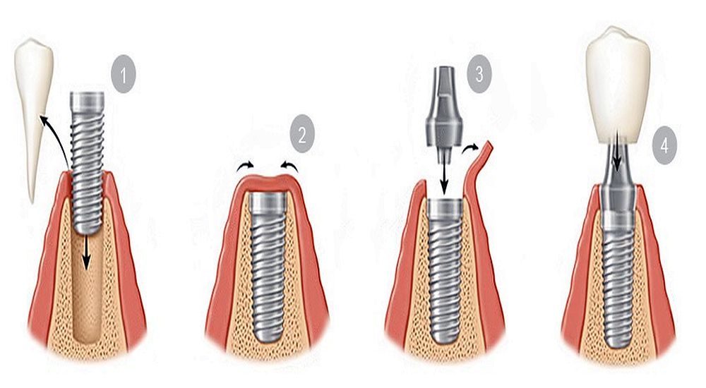 Implantes Dentales