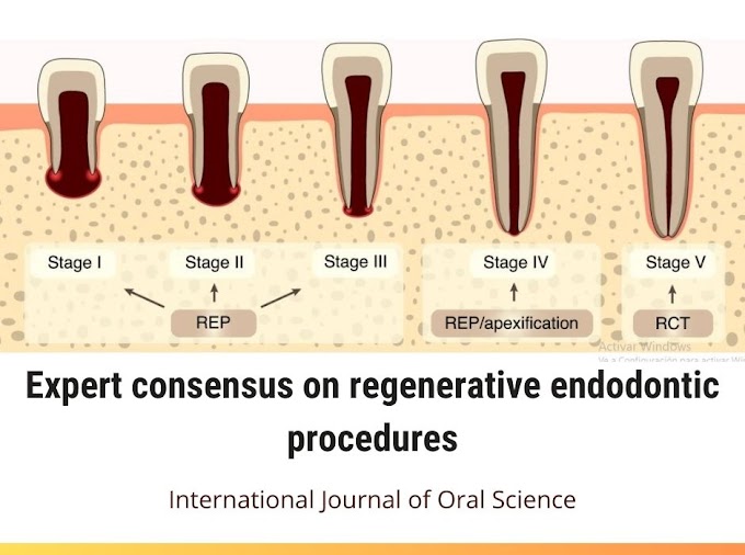 PDF: Expert consensus on regenerative endodontic procedures