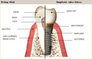 Điểm khác biệt trong giải pháp trồng răng implant