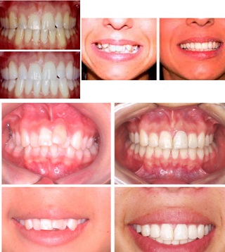 limas-dientes-stripping-comparacion