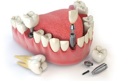 Quy trình cấy ghép implant như thế nào? 2