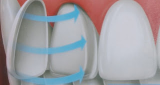 Răng sứ zirconia đẹp an toàn