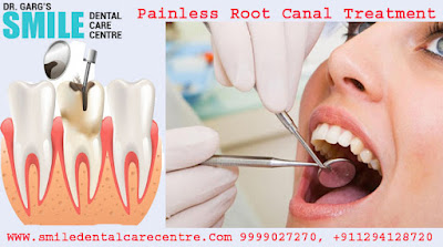 Painless Root Canal Treatment