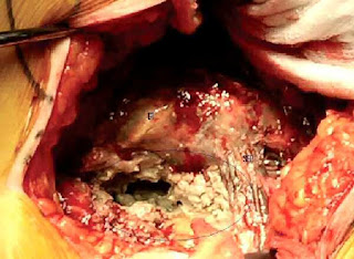 ulcer from chromium poisoning