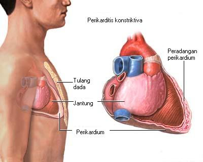 Perikarditis konstriktif