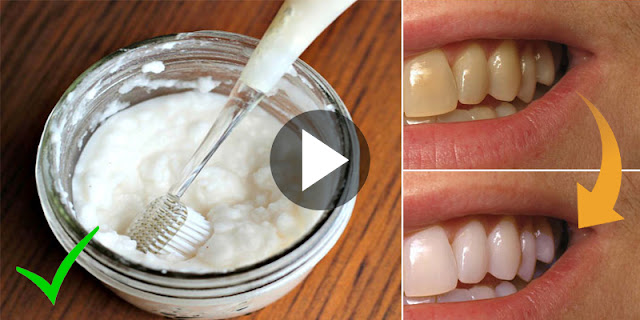 Guaranteed - How To Whiten Teeth Within 2 Minutes By Using 1 Ingredient