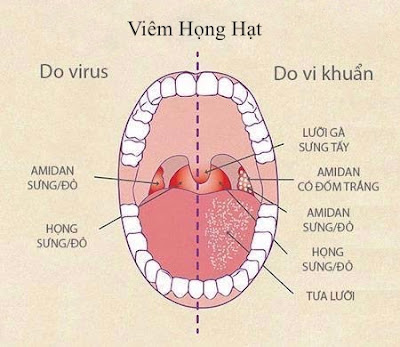 Cùng tìm hiểu về nguyên nhân của bệnh viêm họng hạt