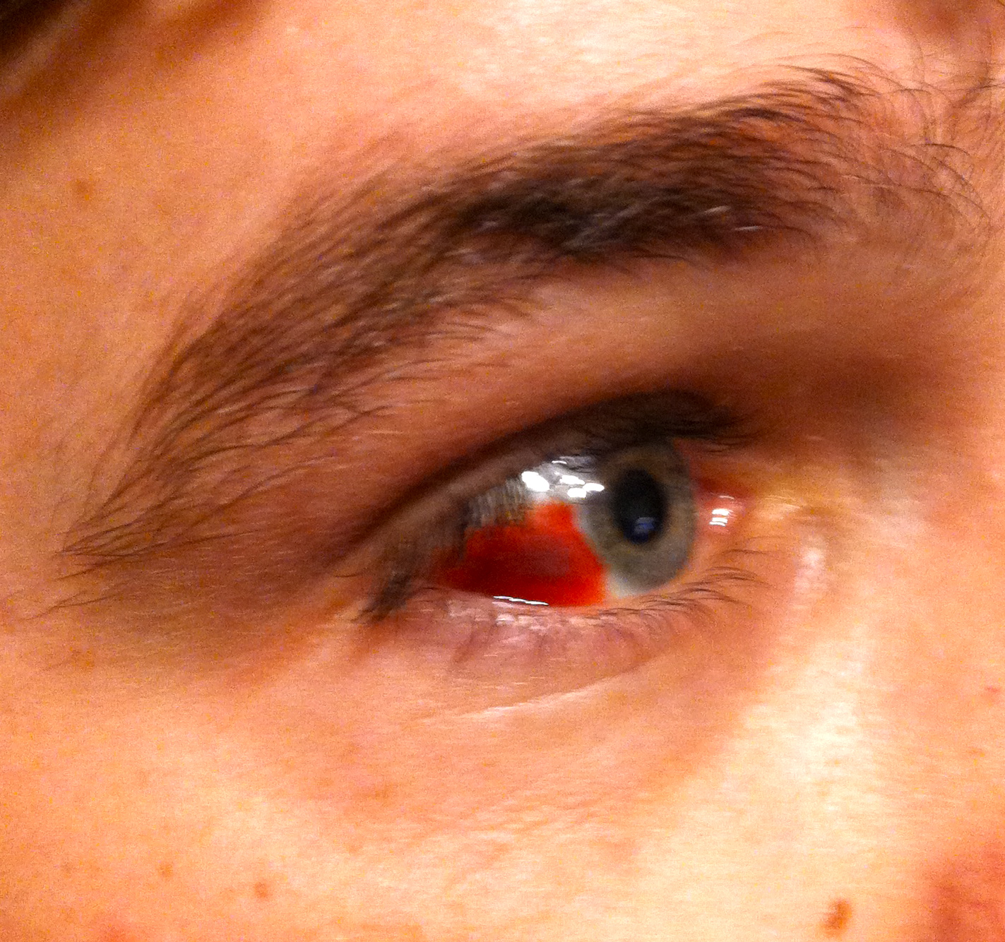 Red Bloody Eye http://mdstatblog.blogspot.com/2012/04/blood-in-eye ...