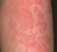 Allergic Reaction Bumps on Skin