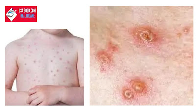 What is Chickenpox?