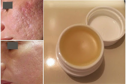 This Unique Homemade Crem Will Help You Get Rid Of Scars Completely Within 2 Weeks!