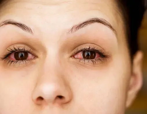 Pink Eye (Conjunctivitis): Symptoms, Causes, and Treatment
