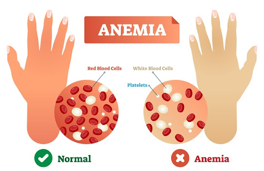 Naturopathy Treatment For Anemia