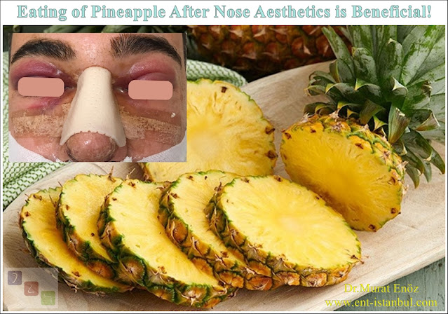 Bromelain, Pineapple, Pineapple, Swelling after Rhinoplasty, Edema, Vitamin C