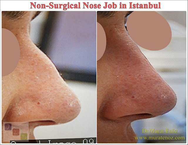 Cost of non-surgical nose job in Istanbul - Cost of non surgical nose job with filler in Istanbul - Cost of non-surgical rhinoplasty in Istanbul - Cost of nose tip filler augmentation in Istanbul - Nose filler injection cost in Turkey - Non-surgical nose job cost in Istanbul - Non-surgical nose job istanbul - Cost of nose filler injection Turkey - Cost of injectable nose job - Cost of liquid rhinoplasty in Istanbul