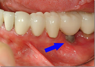 Có nên trồng răng implant phục hình răng mất không?
