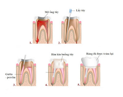 Quy trình lấy tủy răng đạt chuẩn nha khoa