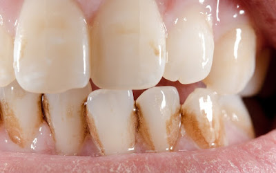 Nguyên nhân chân răng bị ố vàng