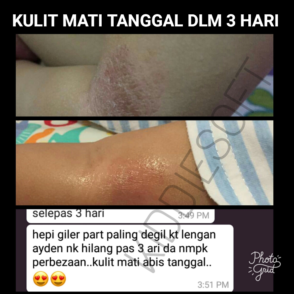 RAWAT EKZEMA SECARA SEMULAJADI: Rawat Ekzema Secara Semulajadi