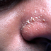 Pengertian dan Penyebab Komedo Putih dan Komedo Hitam di Pipi Wajah dan bibir