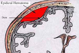 Epidural Hematoma