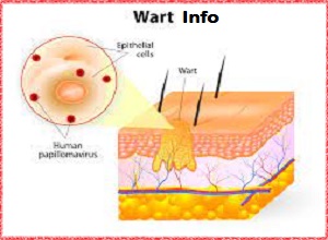 What Causes Warts