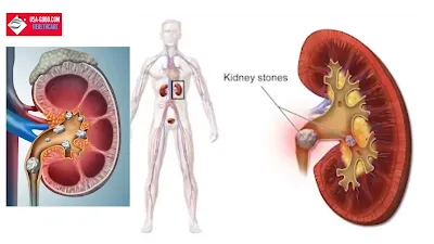 What is a kidney stone?