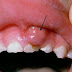 Tác hại của viêm chân răng có mủ 