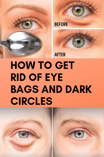 11 Ways to Get Rid of Dark Circles and Bags Under Eyes