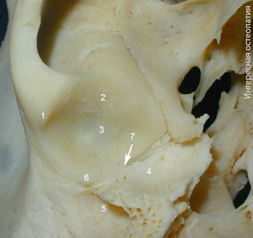 Основание правой височной кости. 1 - скуловой отросток височной кости, 2 - височный выступ, 3 - нижнечелюстная ямка, 4 - барабанная часть височной кости, 5 - наружный слуховой проход, 6 - задний суставной бугорок, 7 – барабанно-чешуйчатая щель.