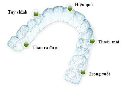Thông tin về kỹ thuật niềng răng invisalign